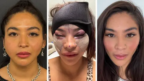 Julia Gilando A composite of Julia before and post surgery. In the before picture she is looking at the camera and wearing silver star earrings and a silver chain necklace. In the middle picture she has plasters on her face and some pen marks can still be seen. Her eyes are puffy and purple. The third picture shows her with no bandages or plasters. Her long dark hair hangs either side of her face.
