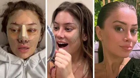 @hotgirlenhancements A composite image showing Emily, a woman with long brown hair, in recovery, smiling into a mirror  with sticking plasters still on her face and after fully recovering with no bandages on