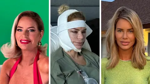Caroline Stanbury Composite of Caroline Stanbury pre and post face lift surgery. In the first picture she is looking at the camera with her blonde hair styled to be swept over her right side. She is wearing a red top and has large gold earrings on and red lipstick. The middle picture shows her with bandages wrapped around her head and wearing what appears to be a hospital gown. In the third picture she has long blonde hairs and is wearing a light green top with a pearl necklace.