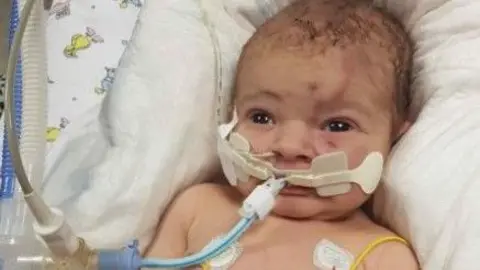 BBC Baby with a breathing tube and forceps delivery face markings.