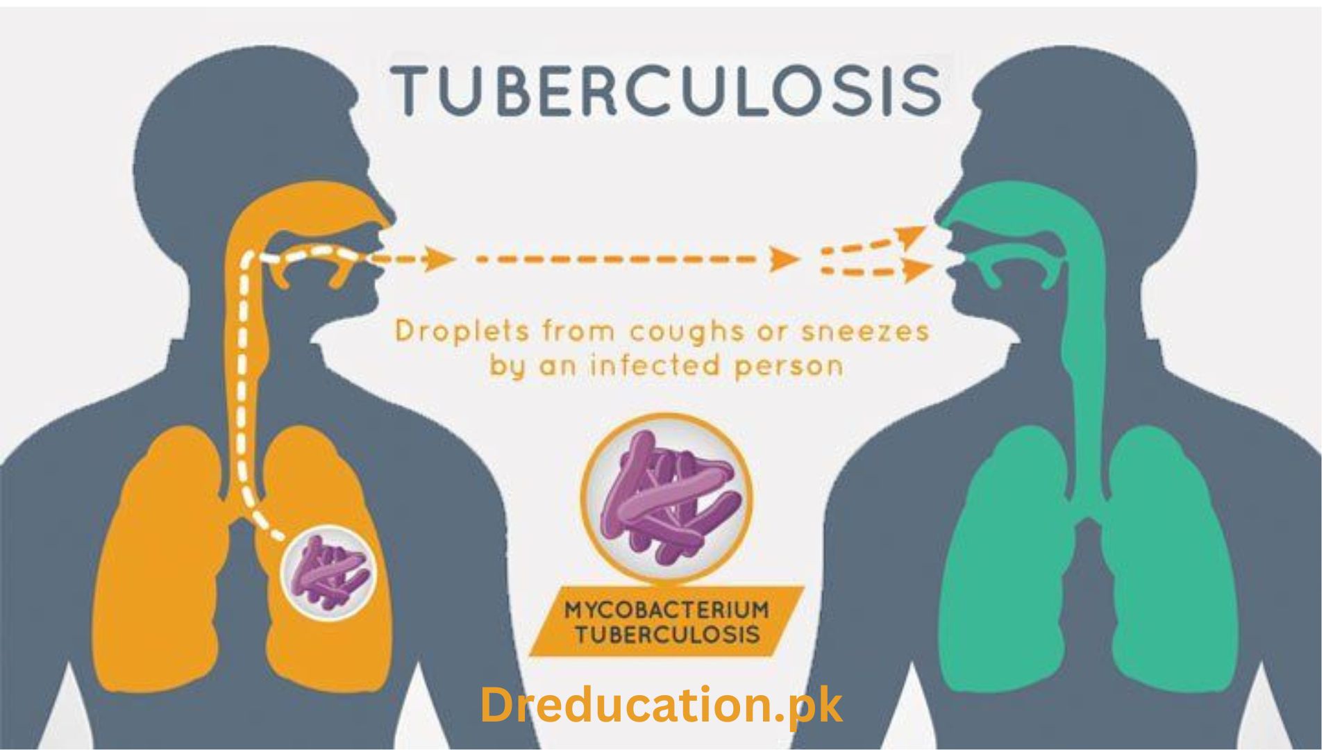 Tuberculosis