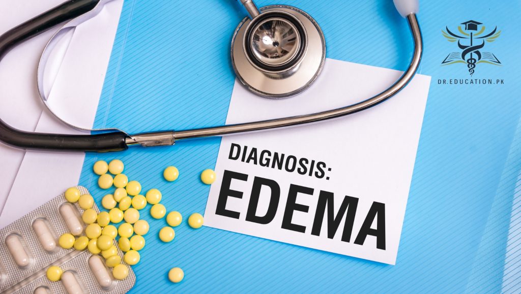 Edema