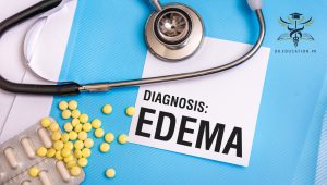 Edema
