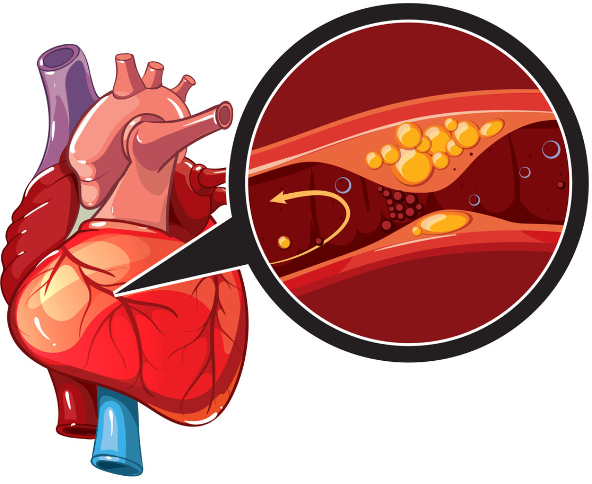 Coronary artery disease