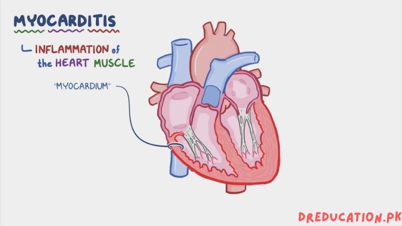 myocarditis