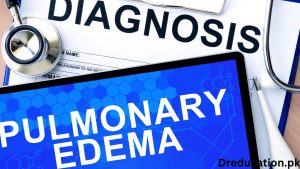 Pulmonary Edema