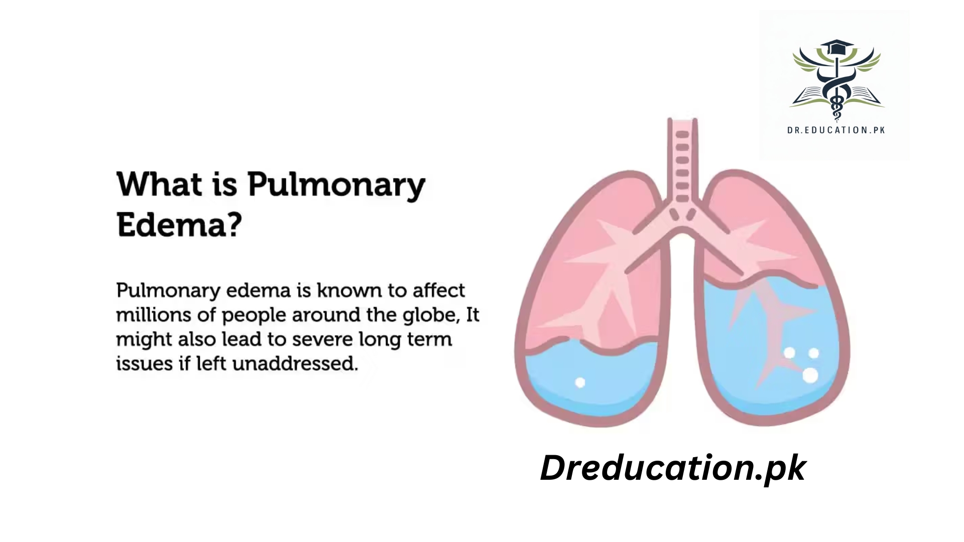 Pulmonary Edema