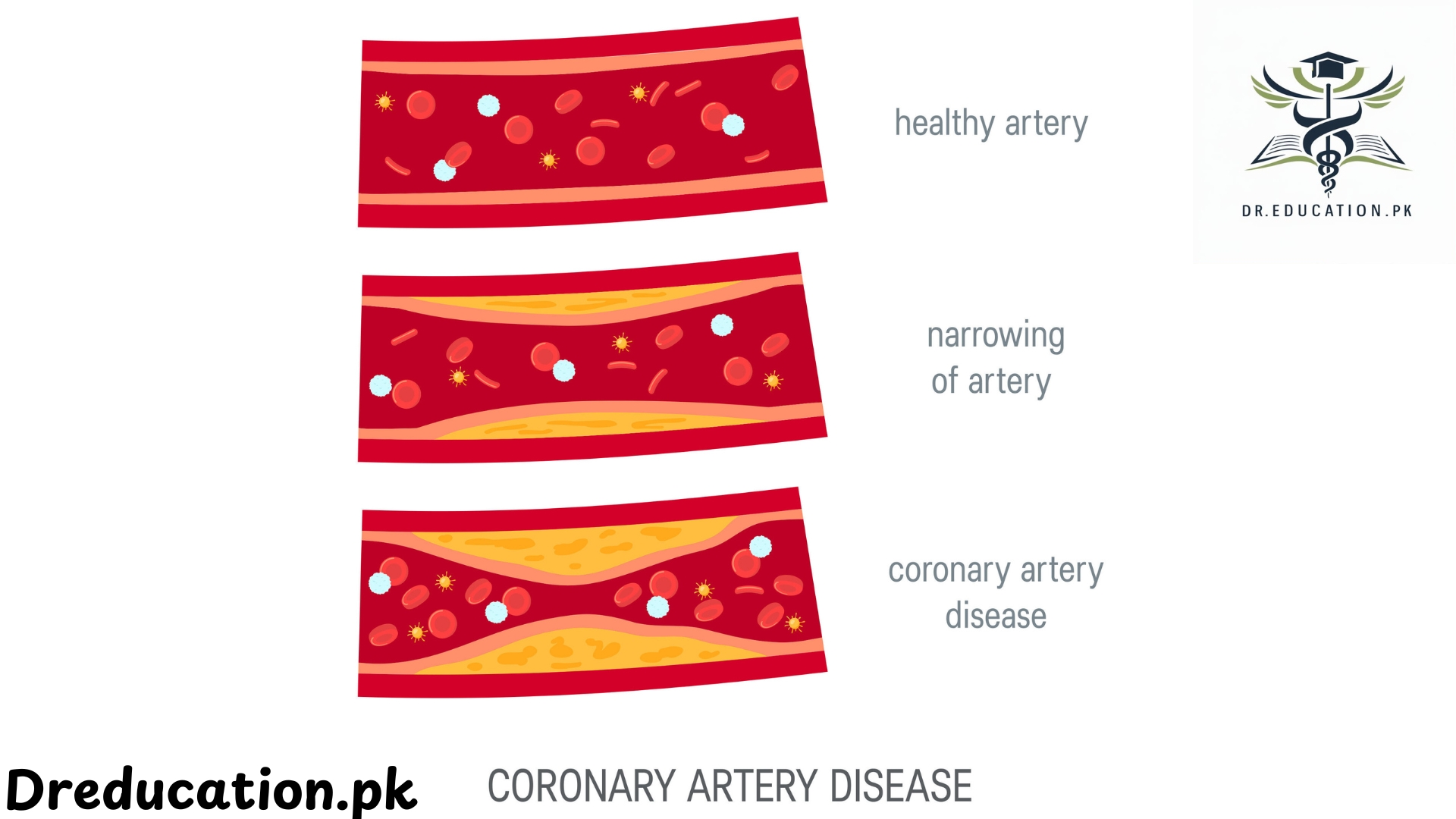 Coronary artery disease