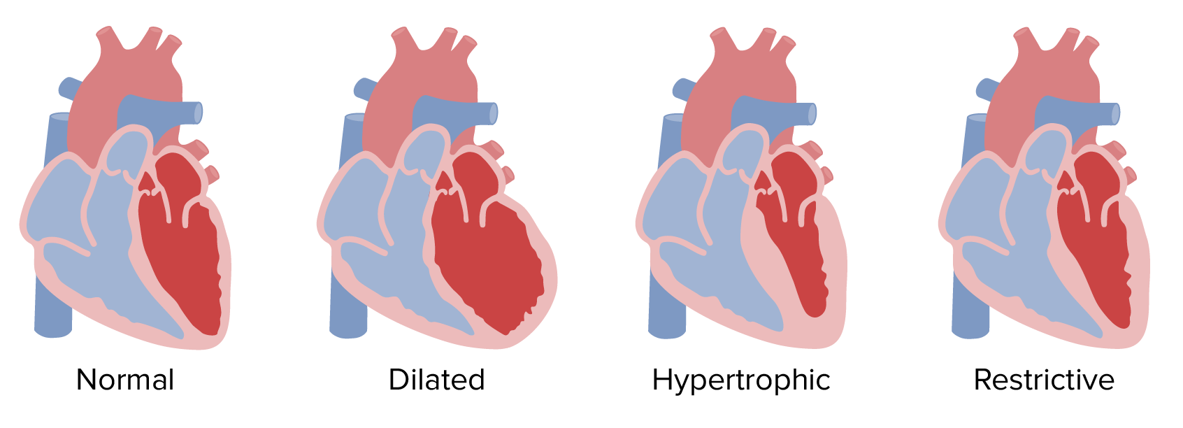 Types of cardiomyopathy