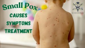 Small Pox