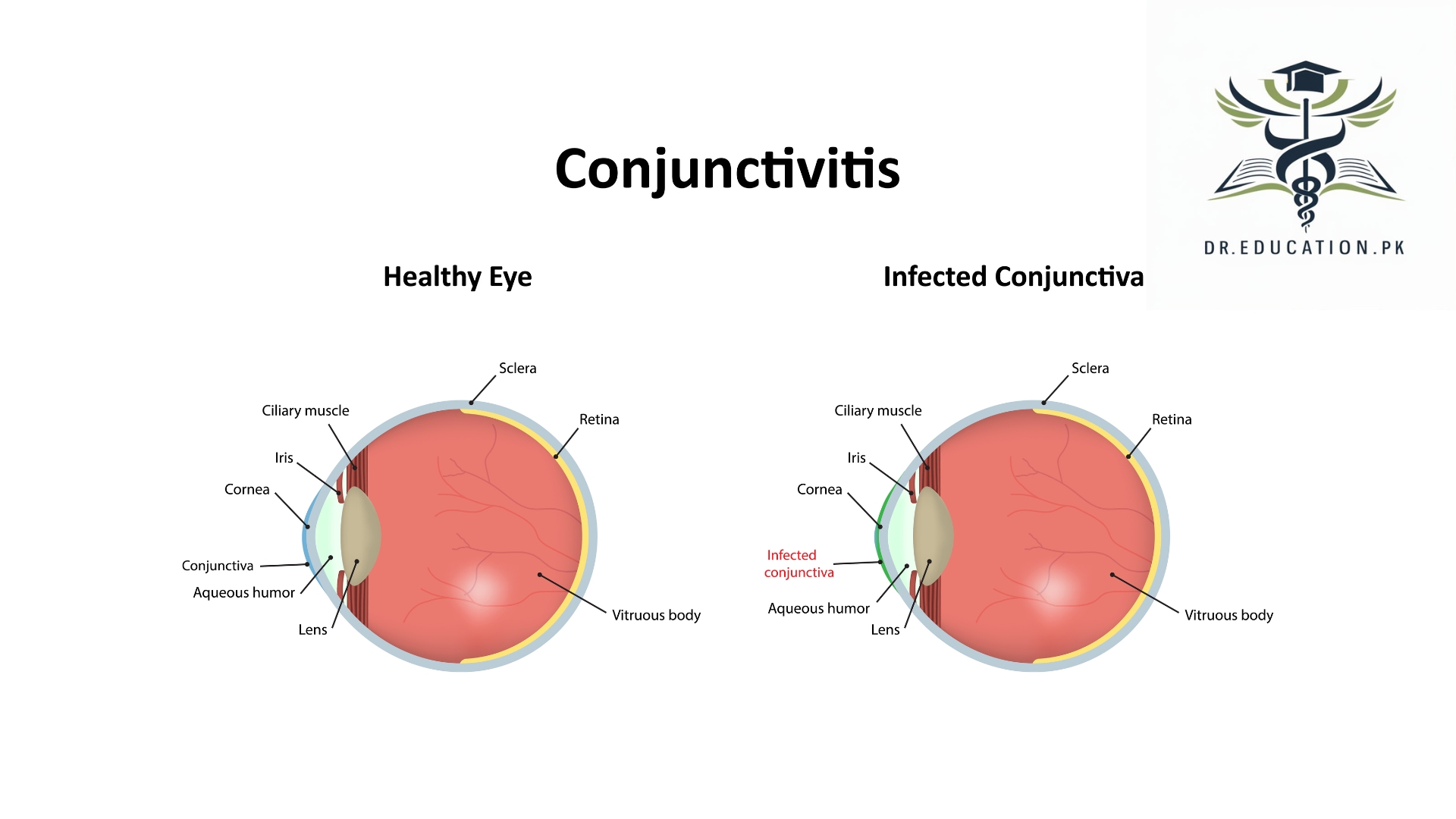 conjunctivitis