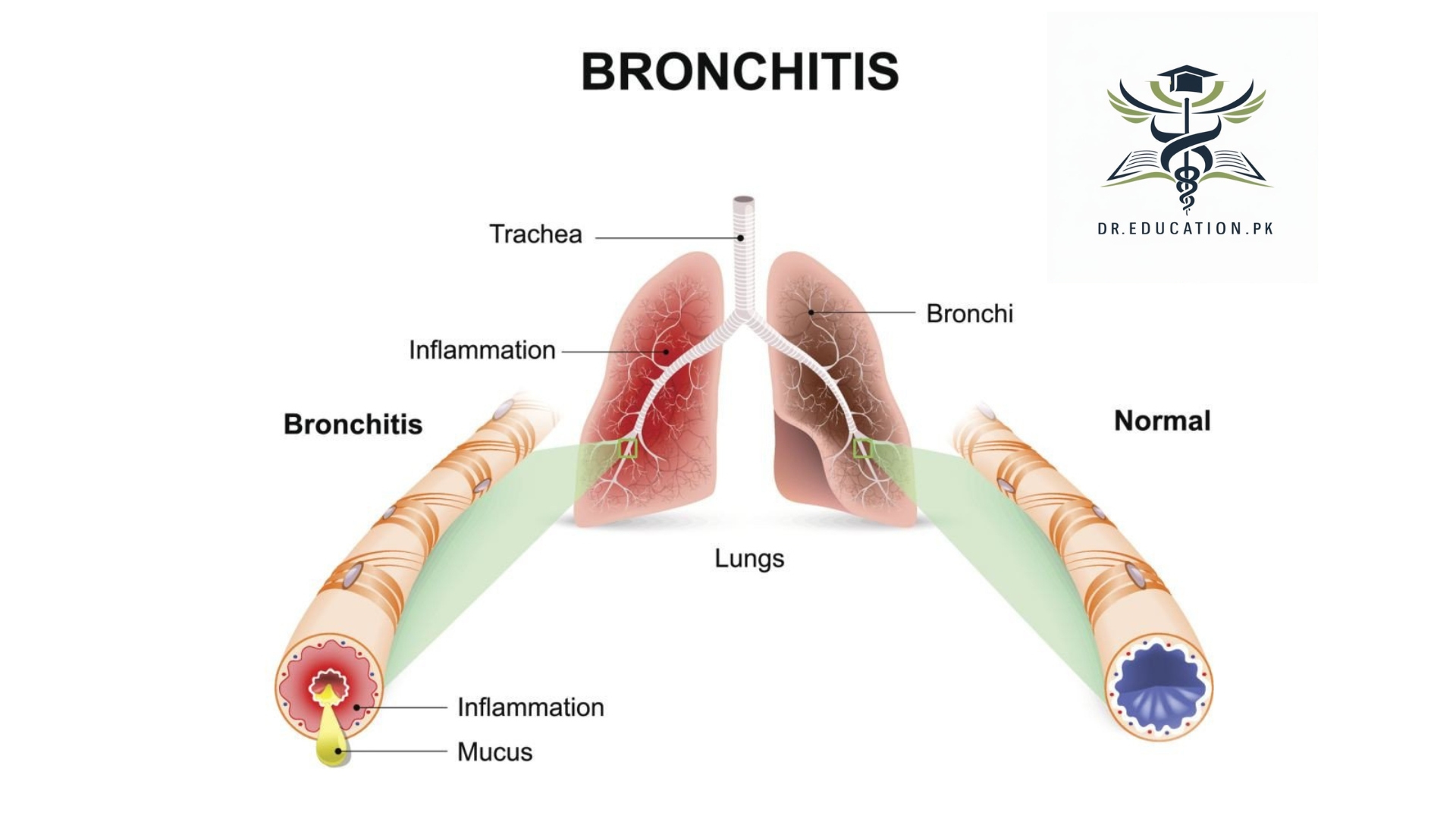Bronchitis