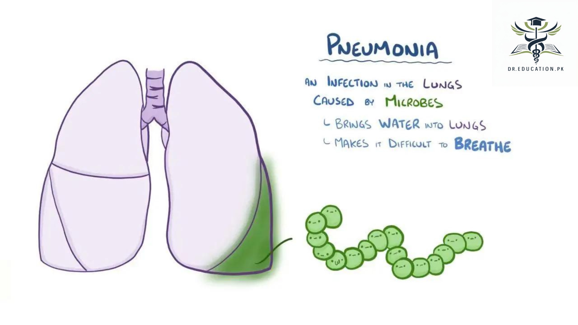 pneumonia