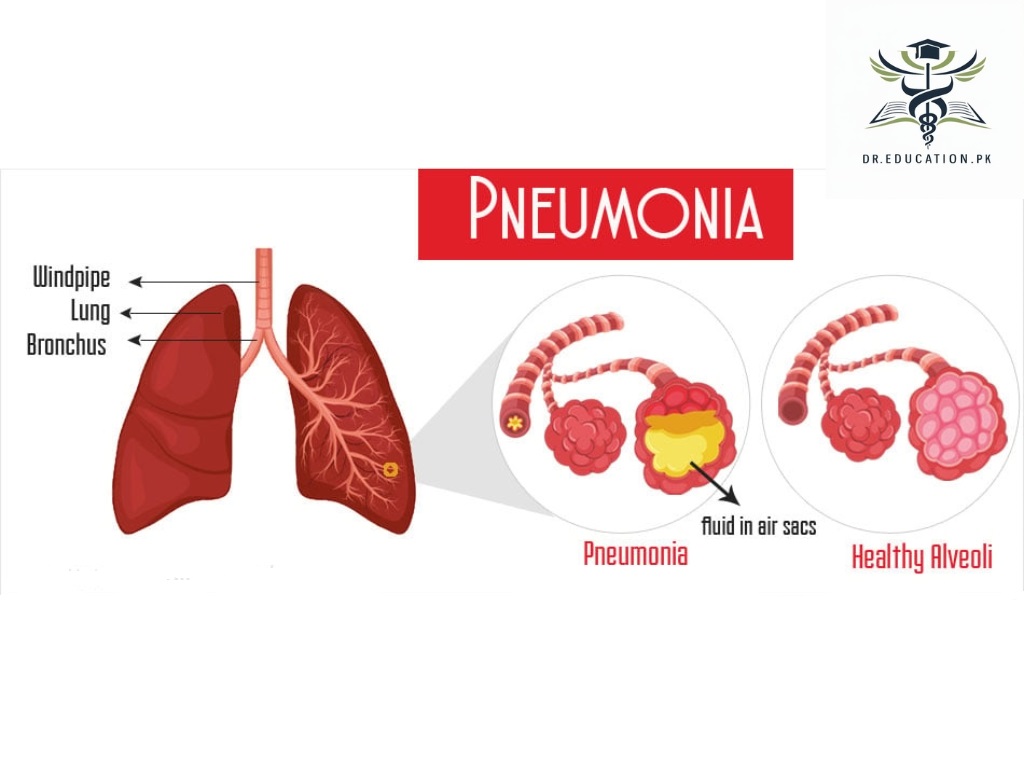 Pneumonia