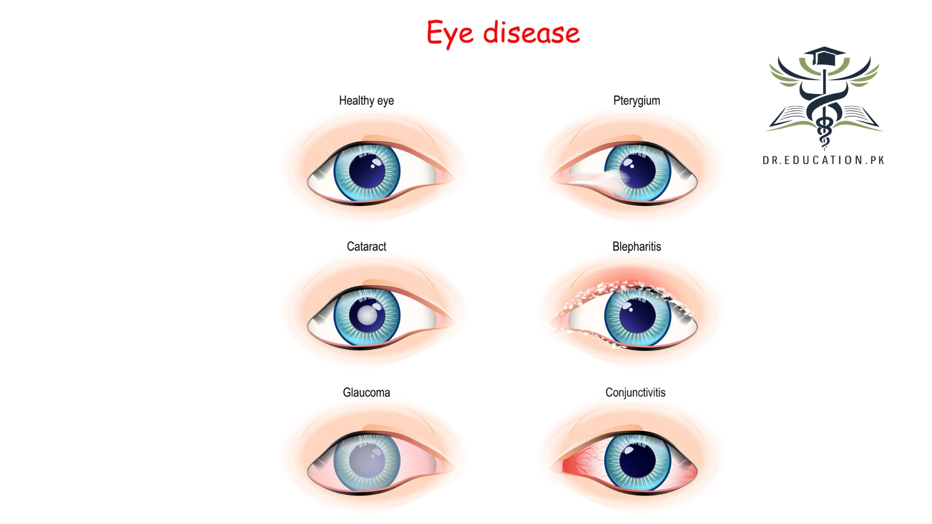 conjunctivitis