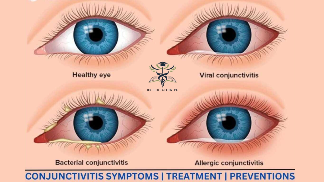 conjunctivitis