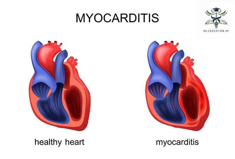 myocarditis