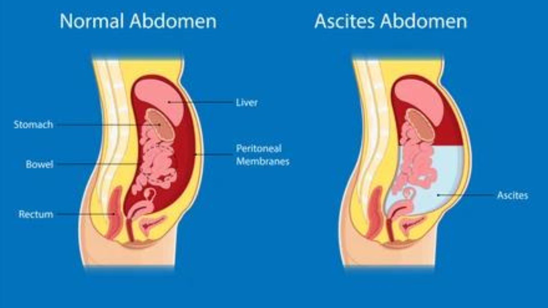 ascites