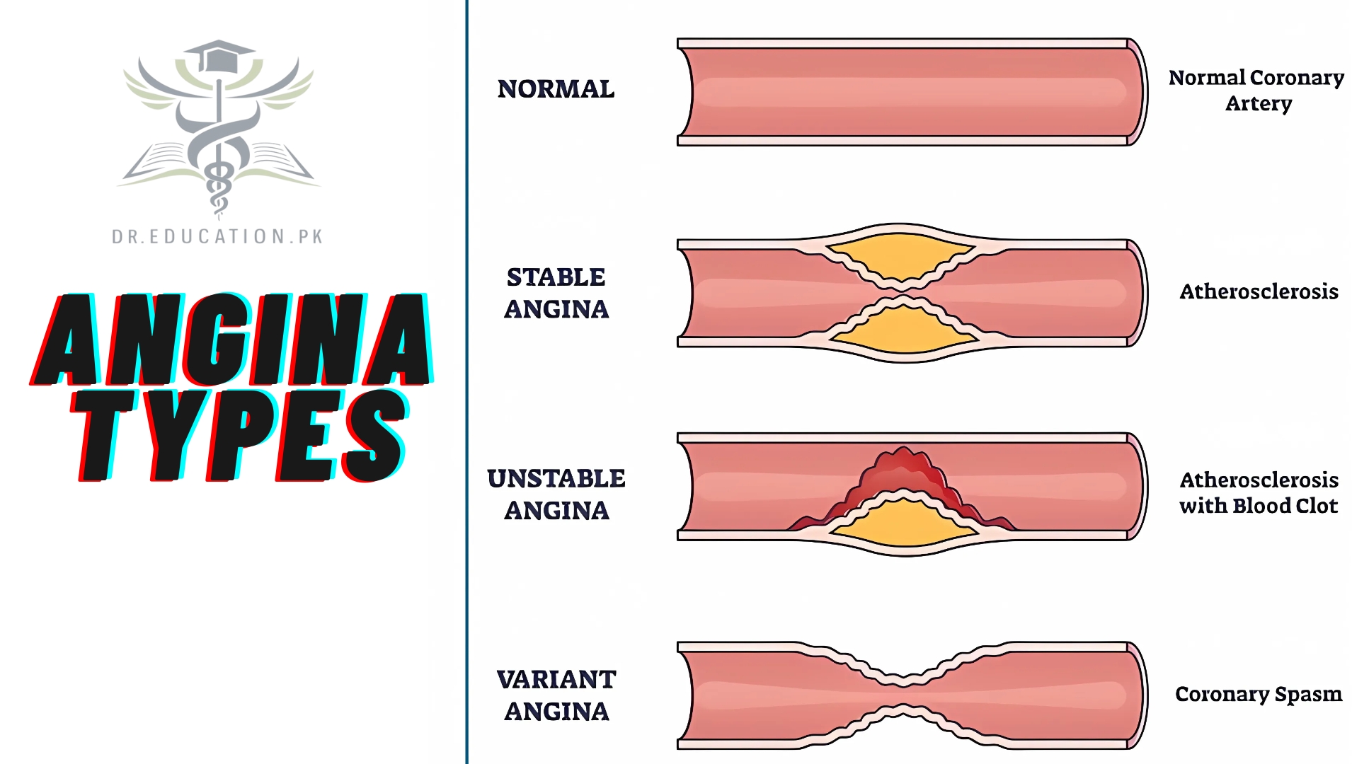 Angina Pectoris