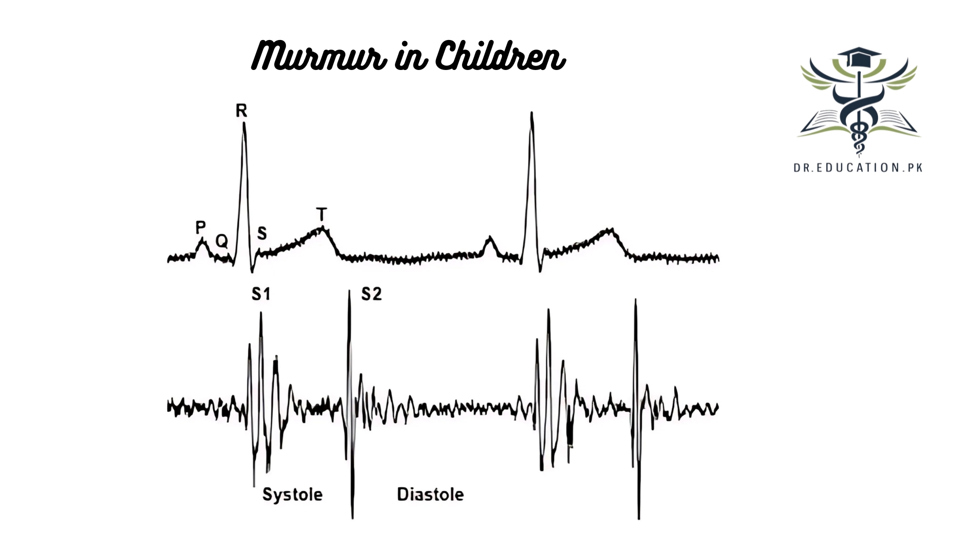 Heart Murmur