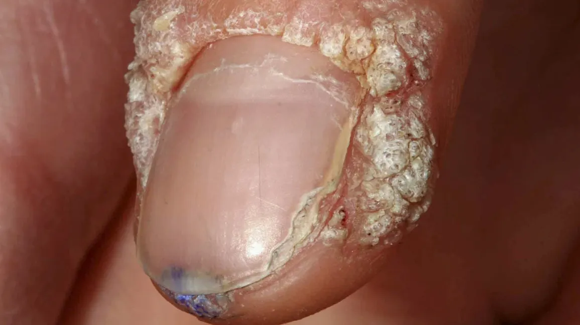 Periungual-warts