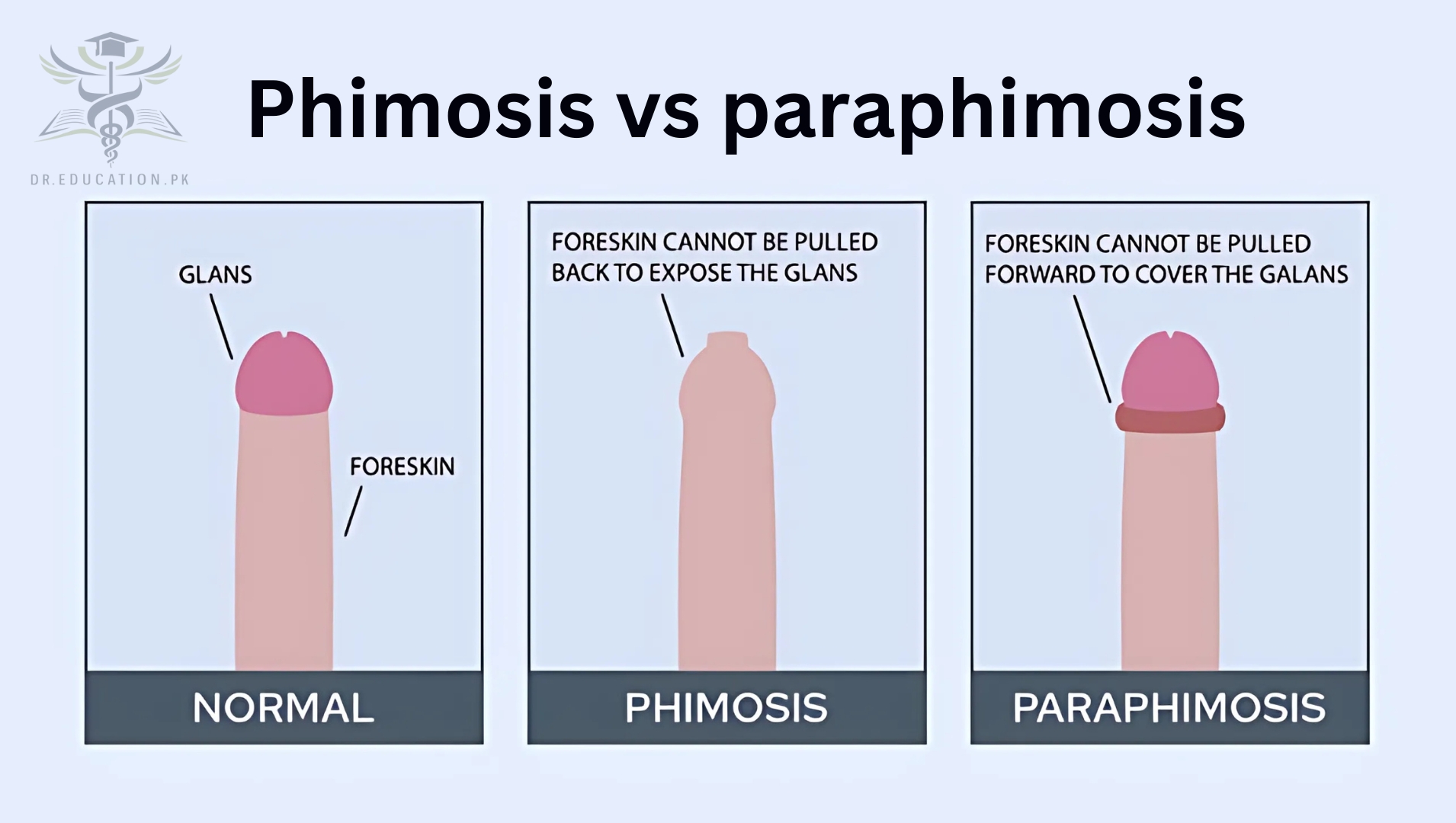 Phimosis