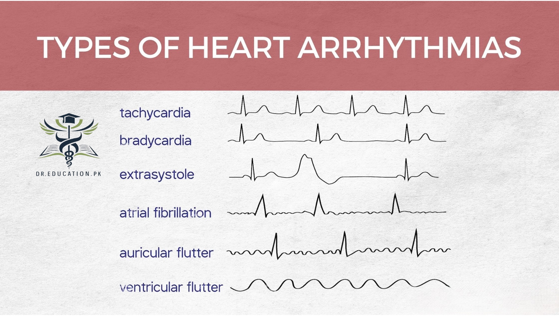 Arrhythmia