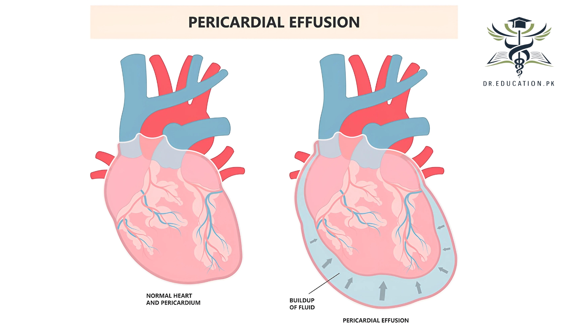 Pericardial Effusion