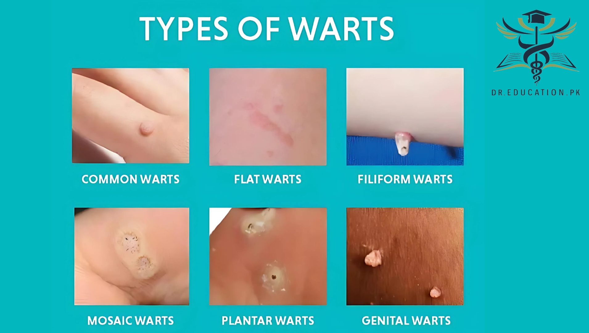 Warts