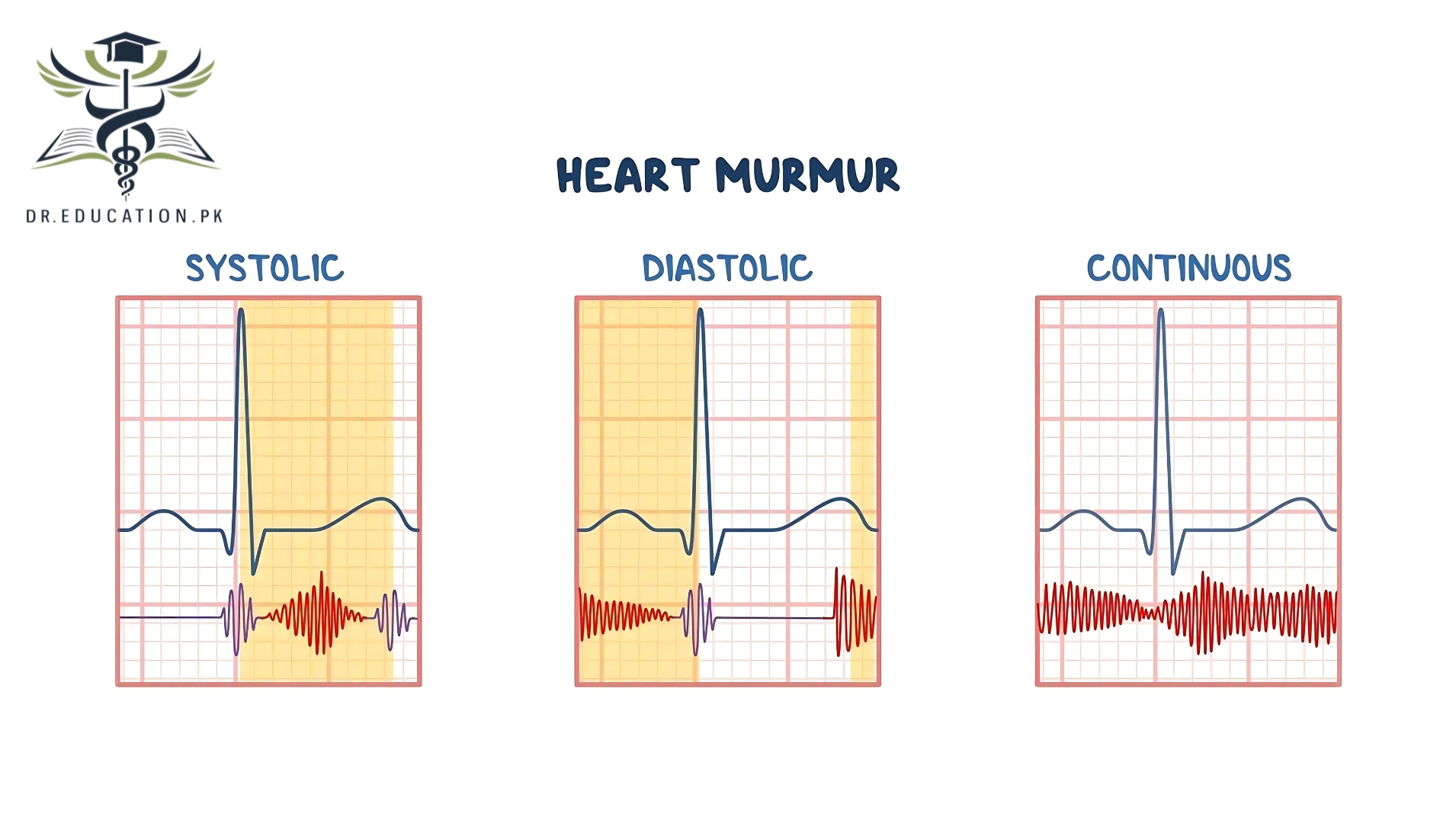 Heart Murmur