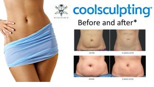 coolsculpting