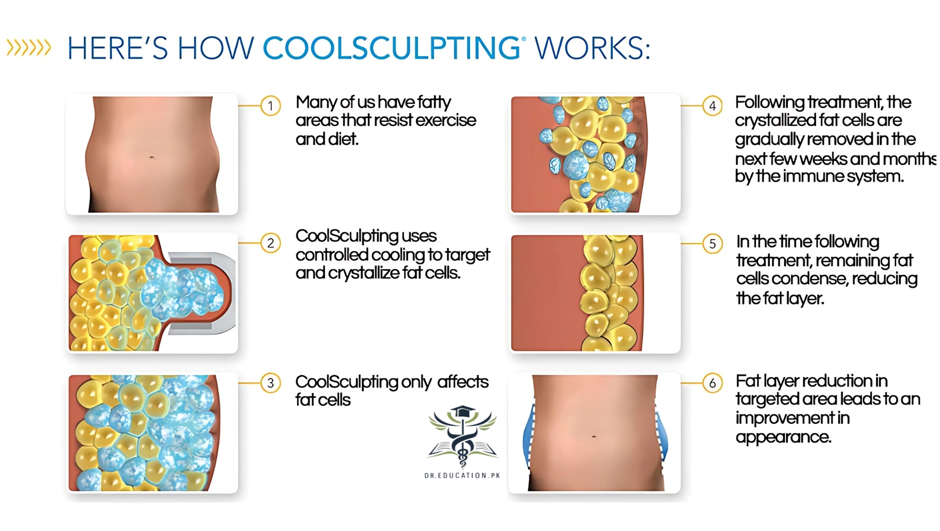 coolsculpting