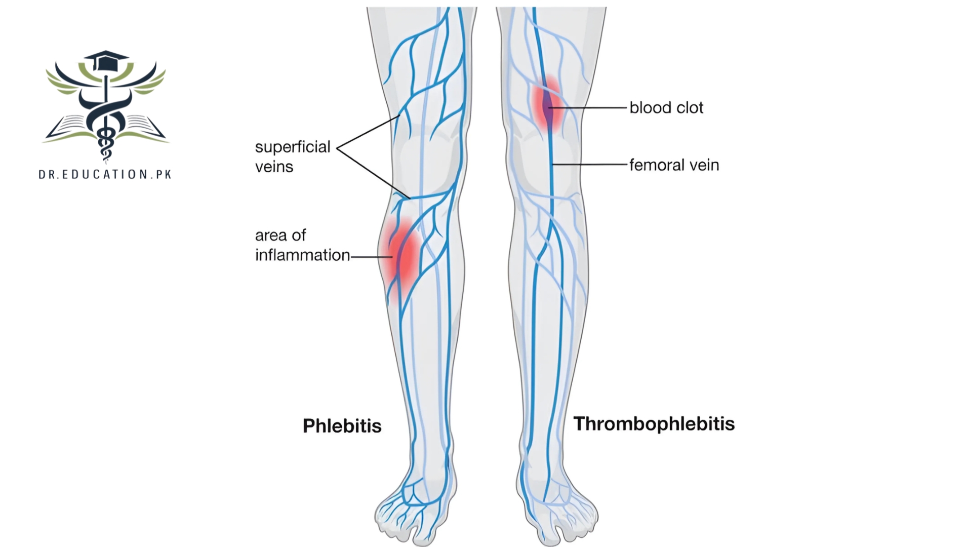 Phlebitis