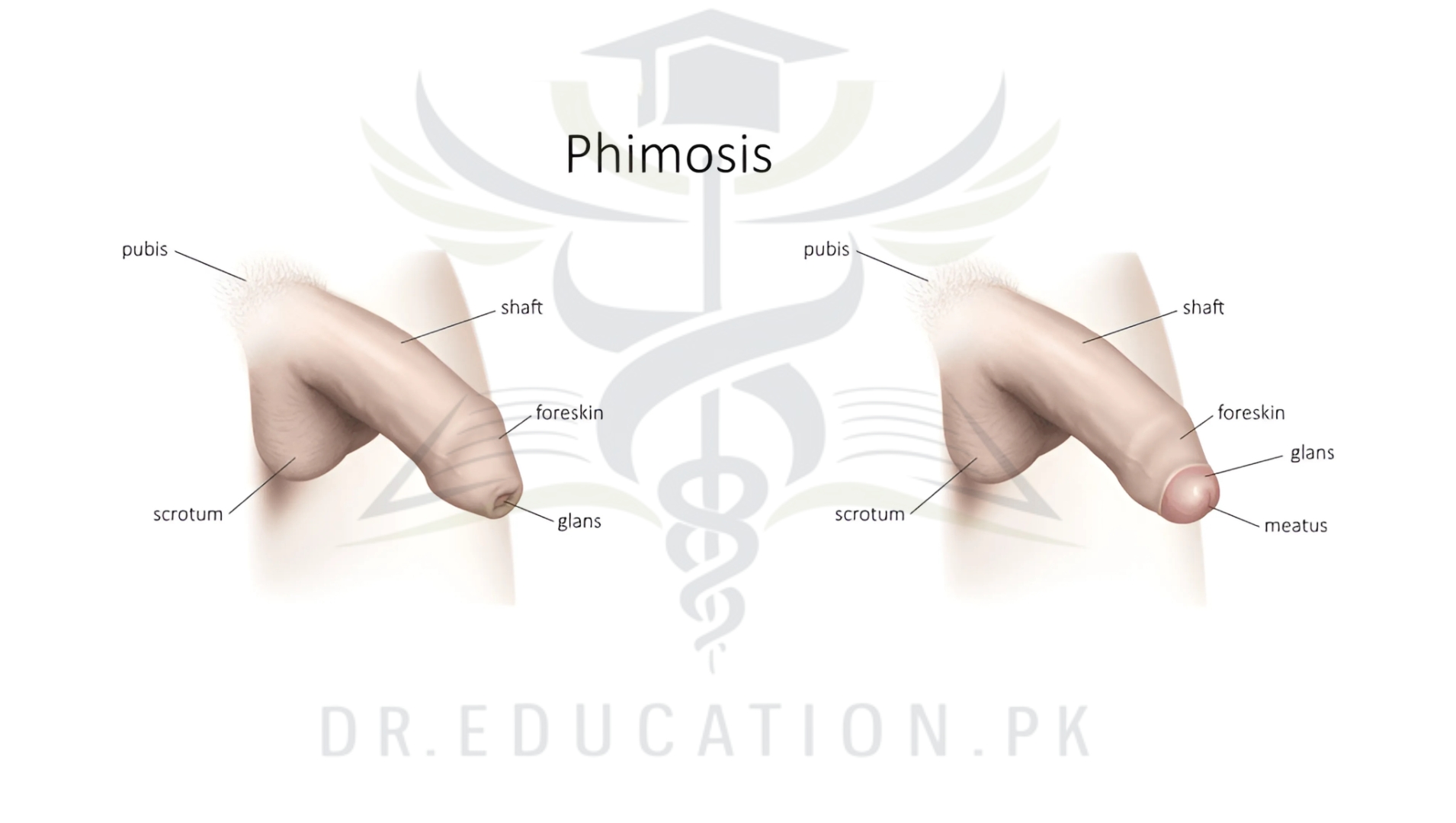 Phimosis