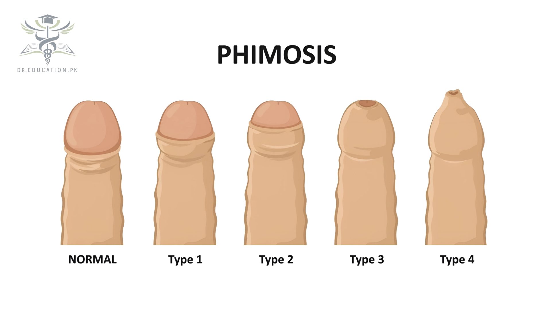 Phimosis