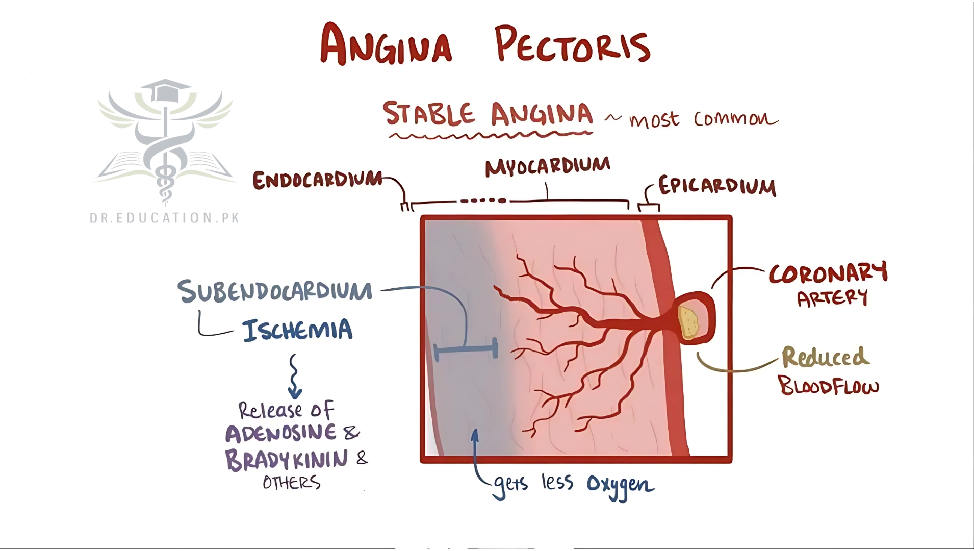 Angina Pectoris