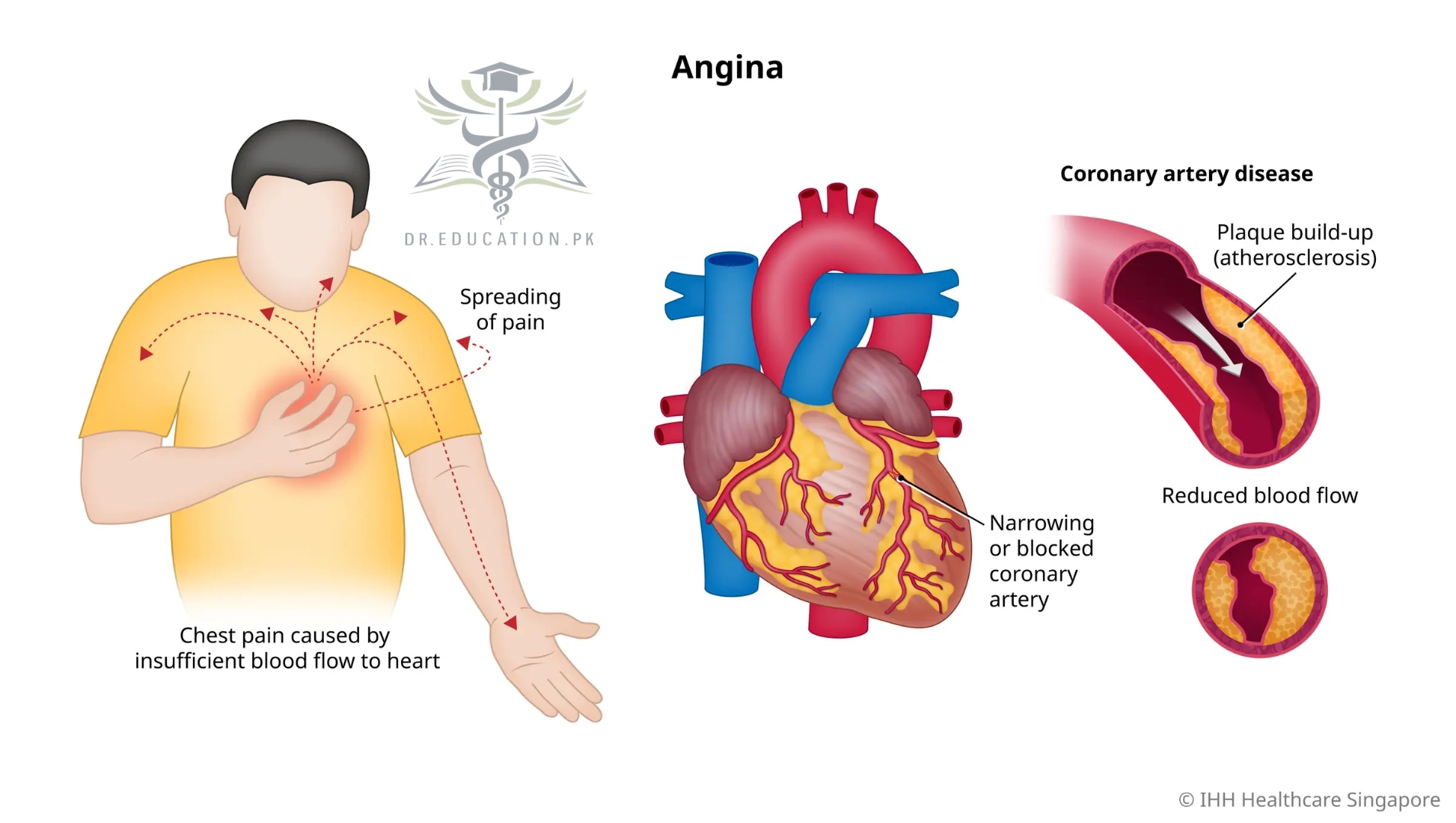 Angina Pectoris