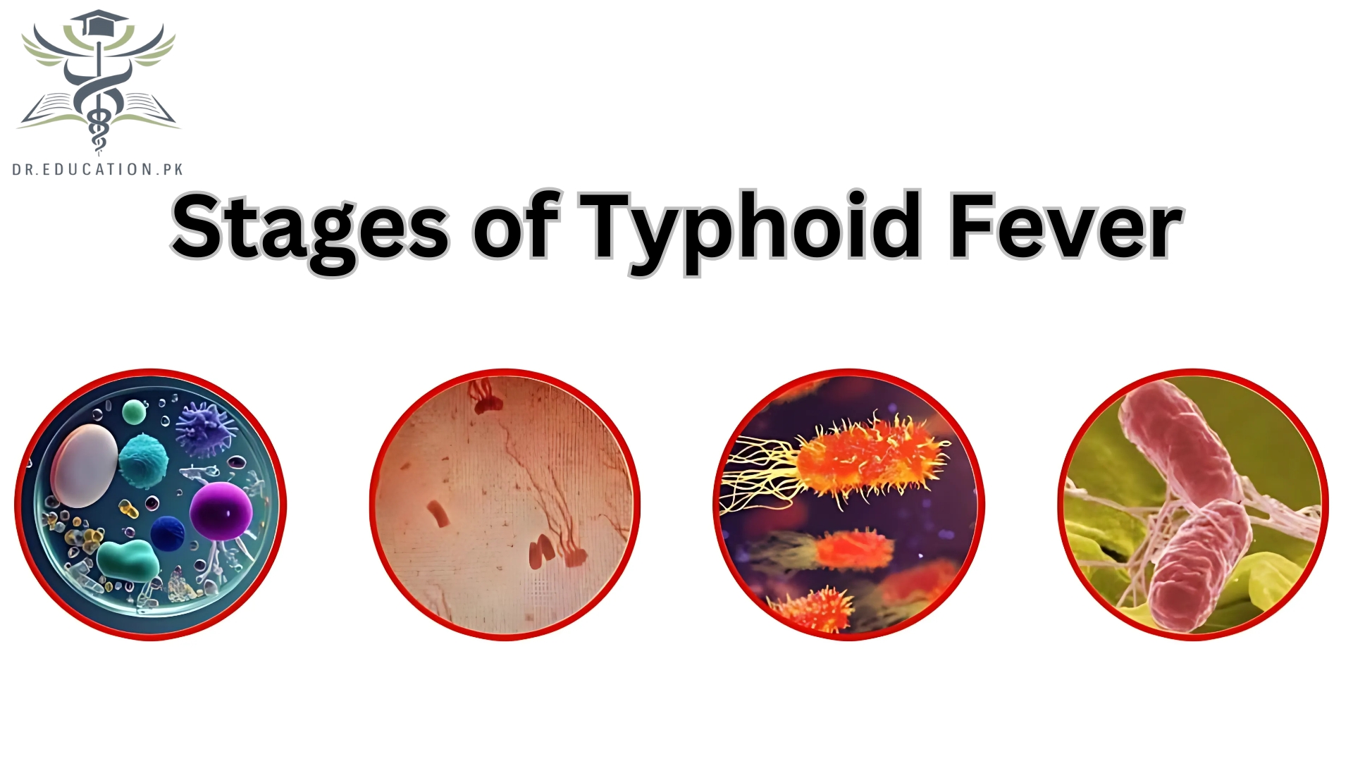 Typhoid Fever