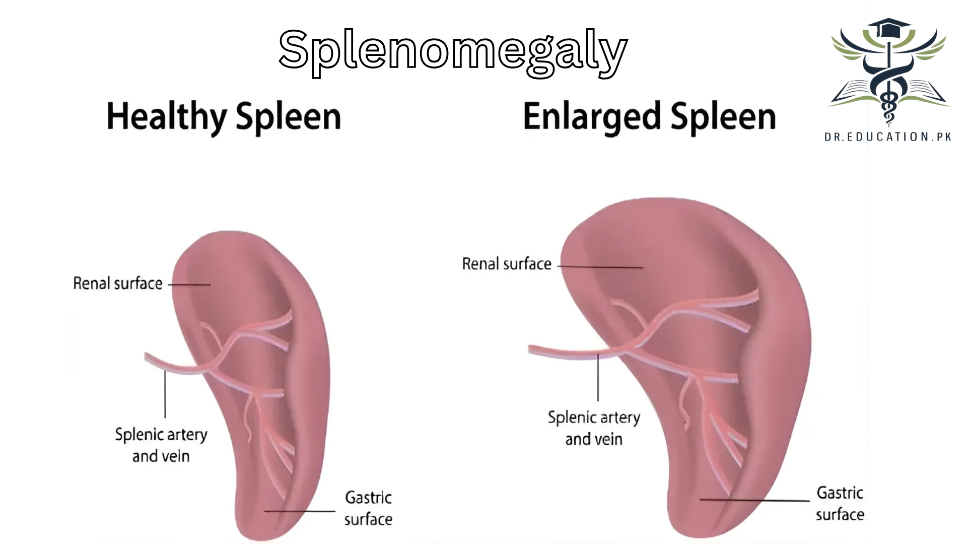 Splenomegaly