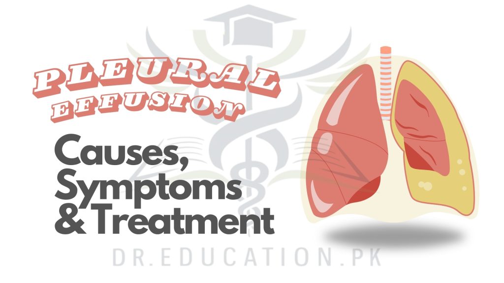 Pleural Effusion