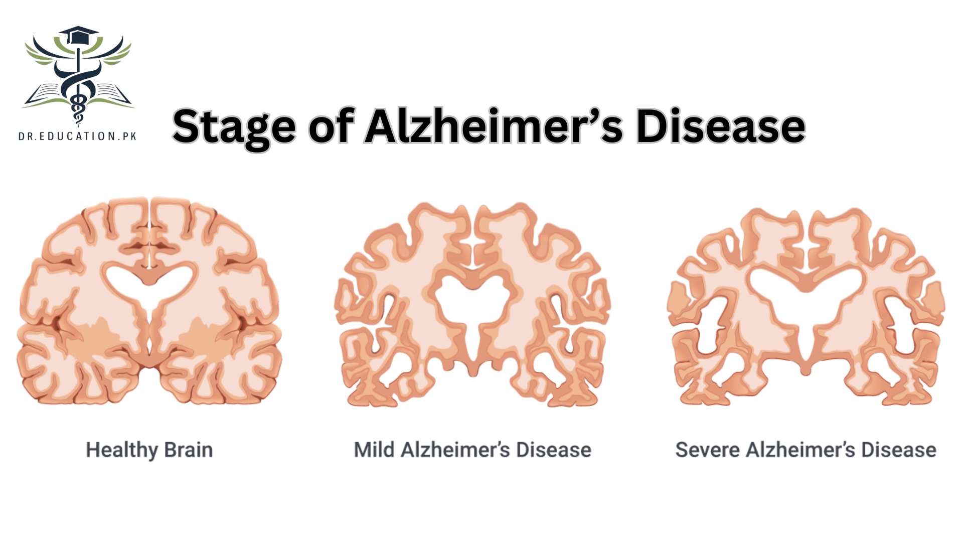 Alzheimer's Disease