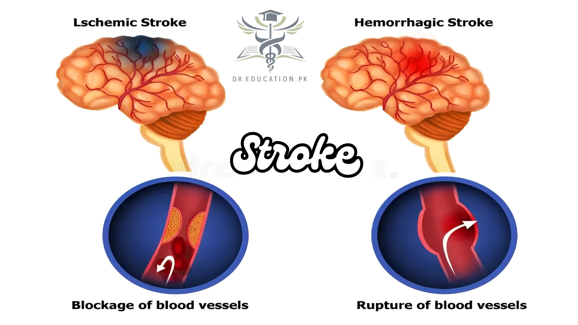 Stroke