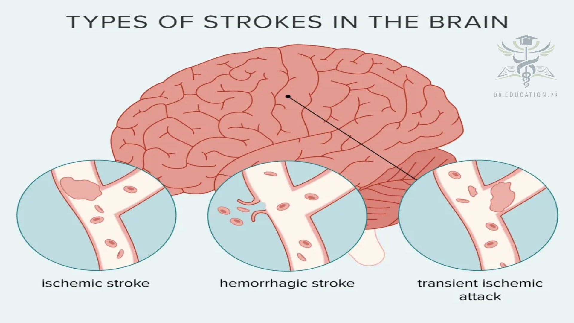 Stroke