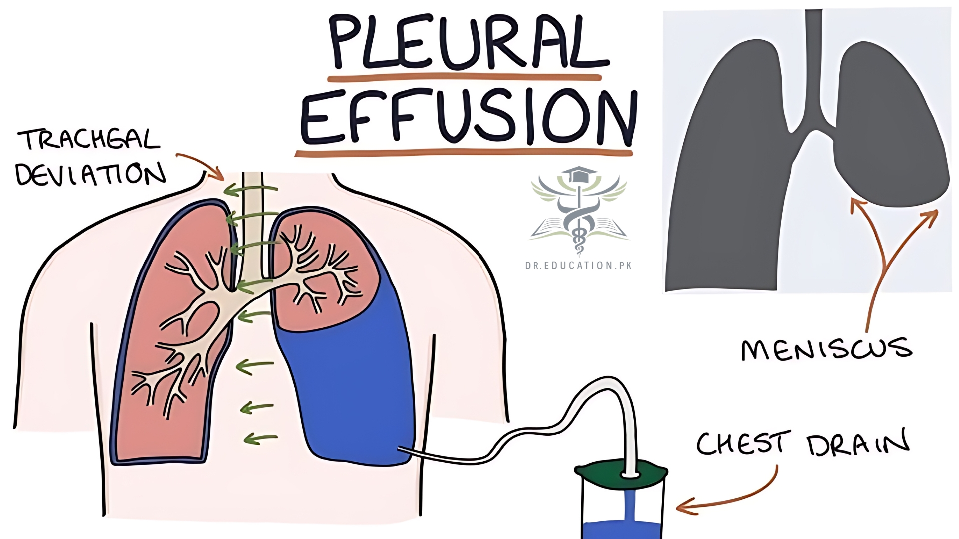 Pleural Effusion
