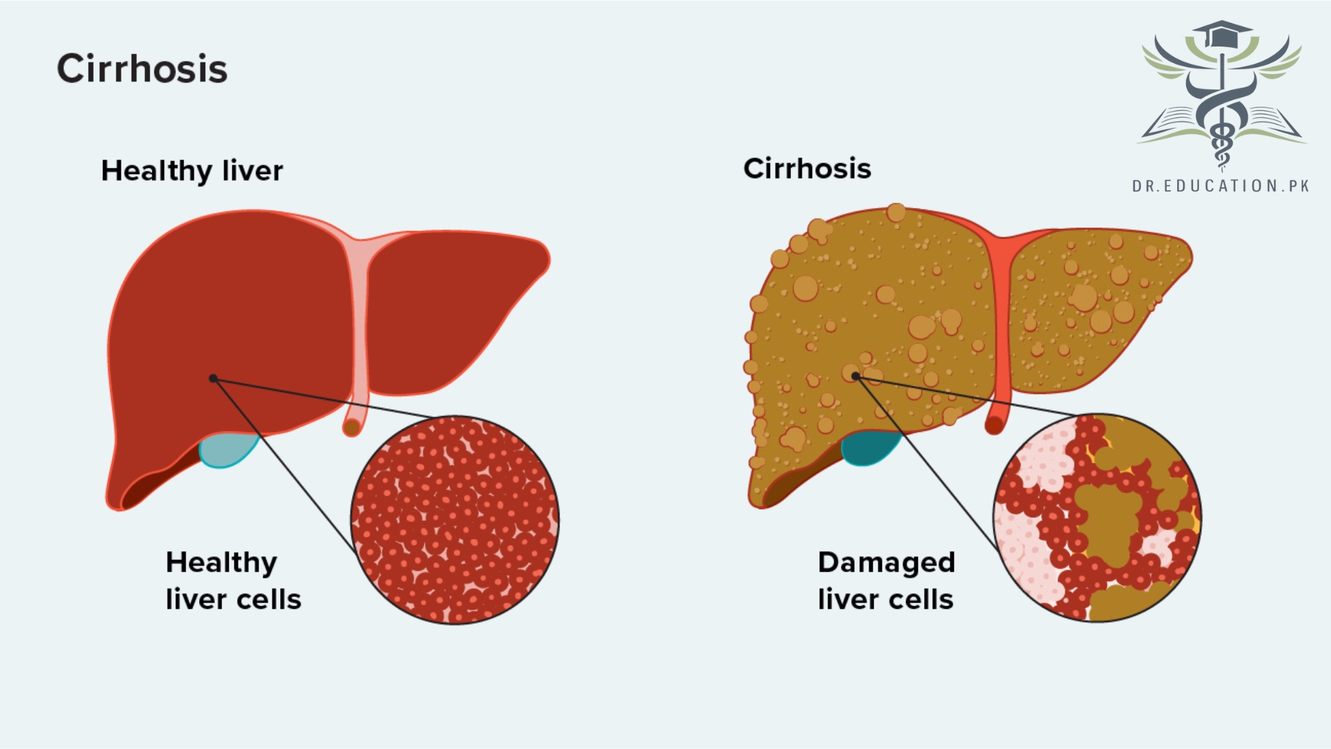 Liver Cirrhosis