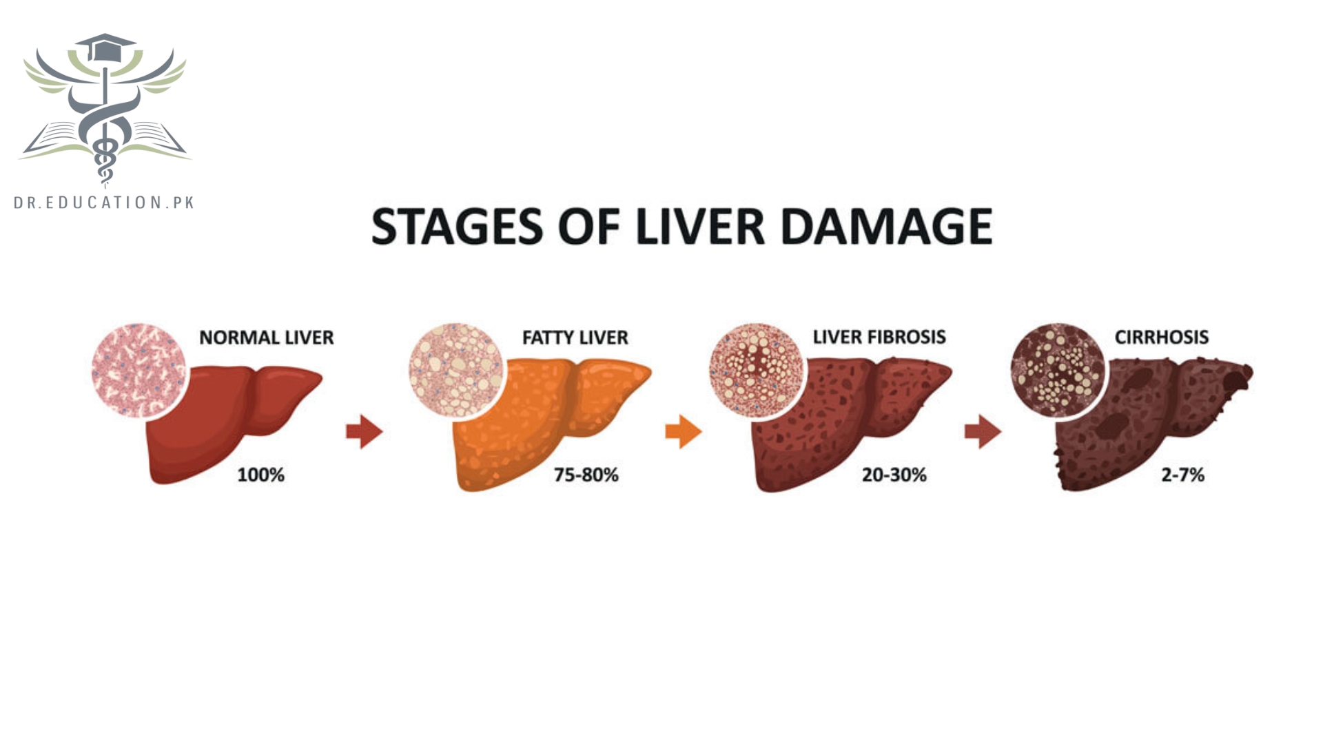 Liver Cirrhosis