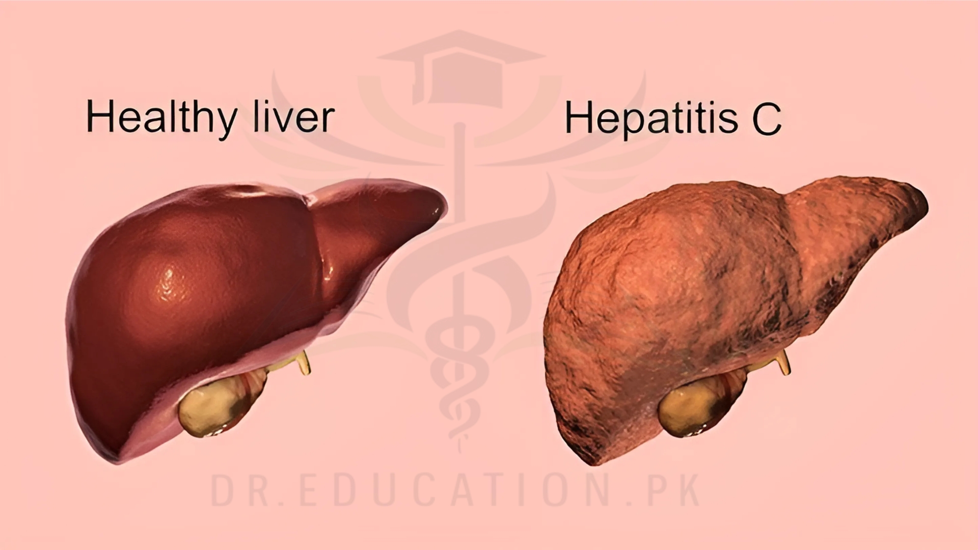 Hepatitis-C