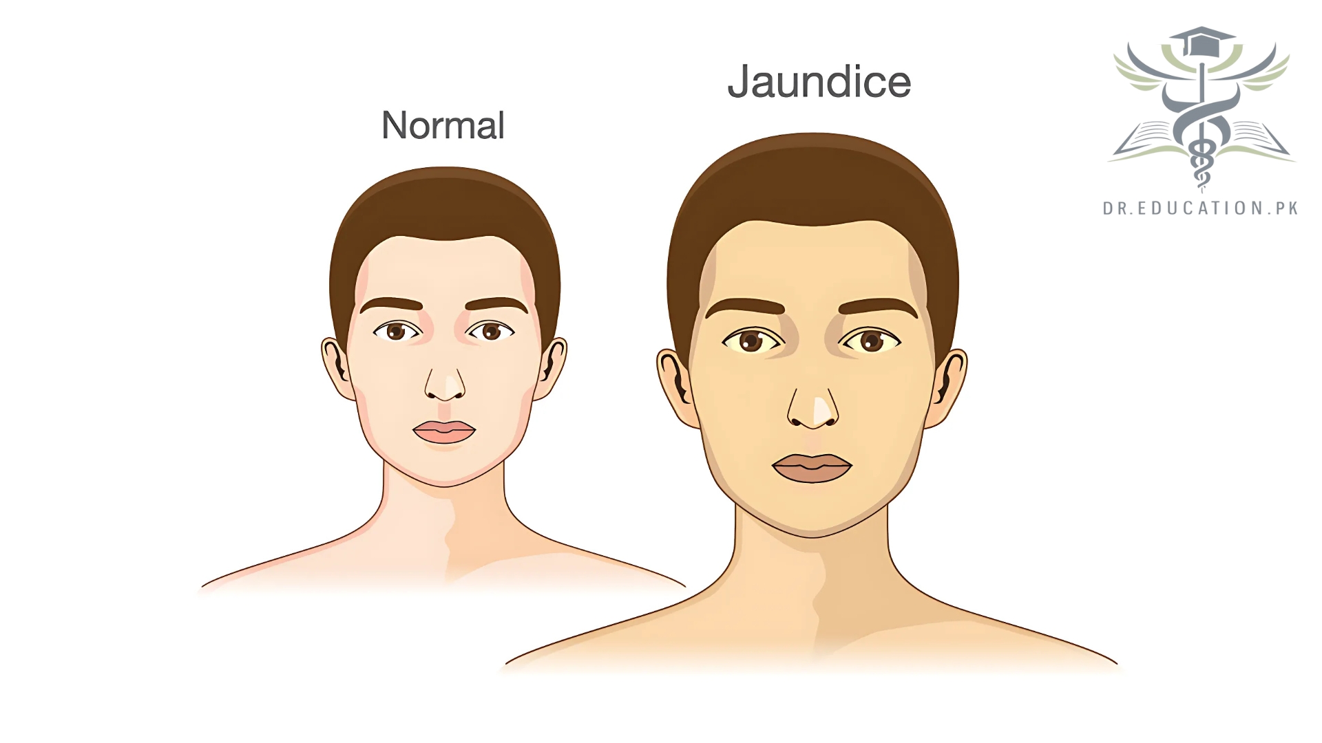 Jaundice