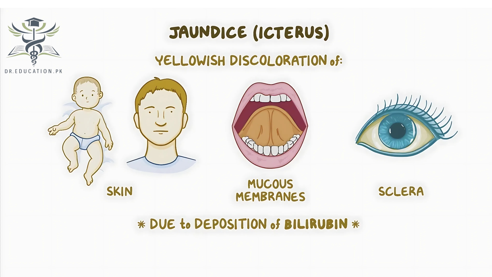 Jaundice