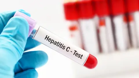 Getty Images A test tube of blood has a sticker on it saying Hepatitis C - Test 